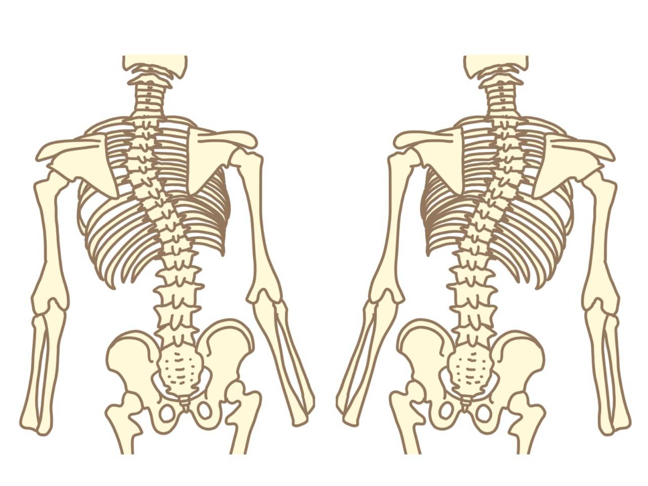 【側彎症の初期サインとは？】接骨院（整骨院）でできる対策を解説